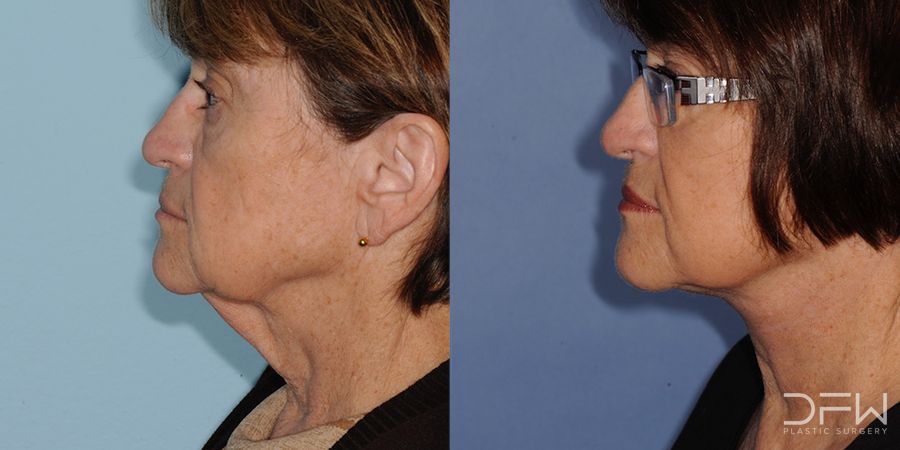 Facelift - Case 7522