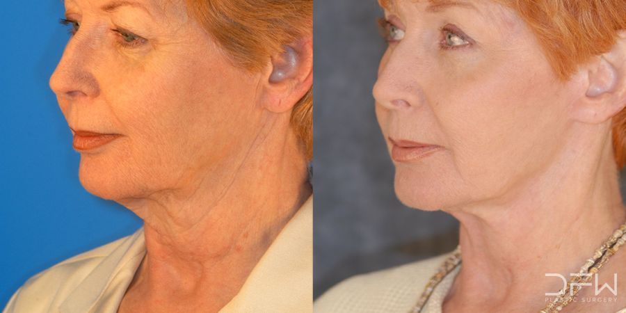 Facelift - Case 7519