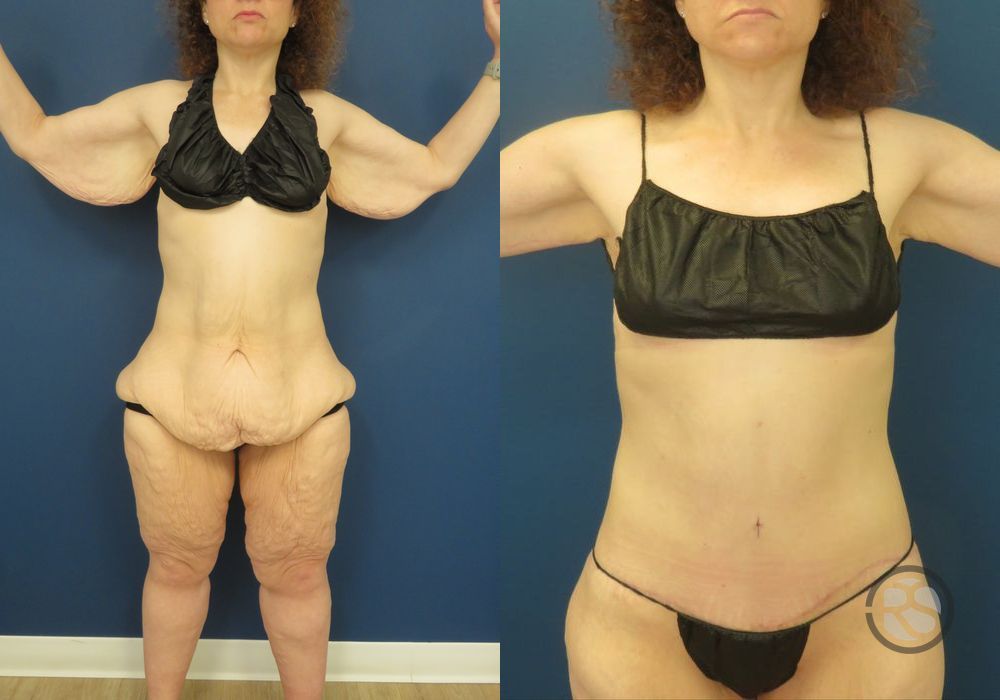 Before photo - Angle 2