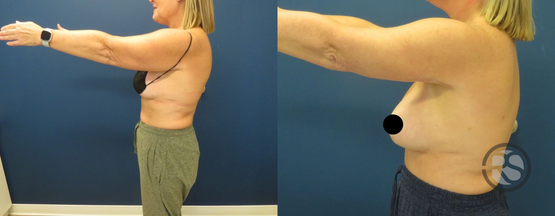 Before photo - Angle 4