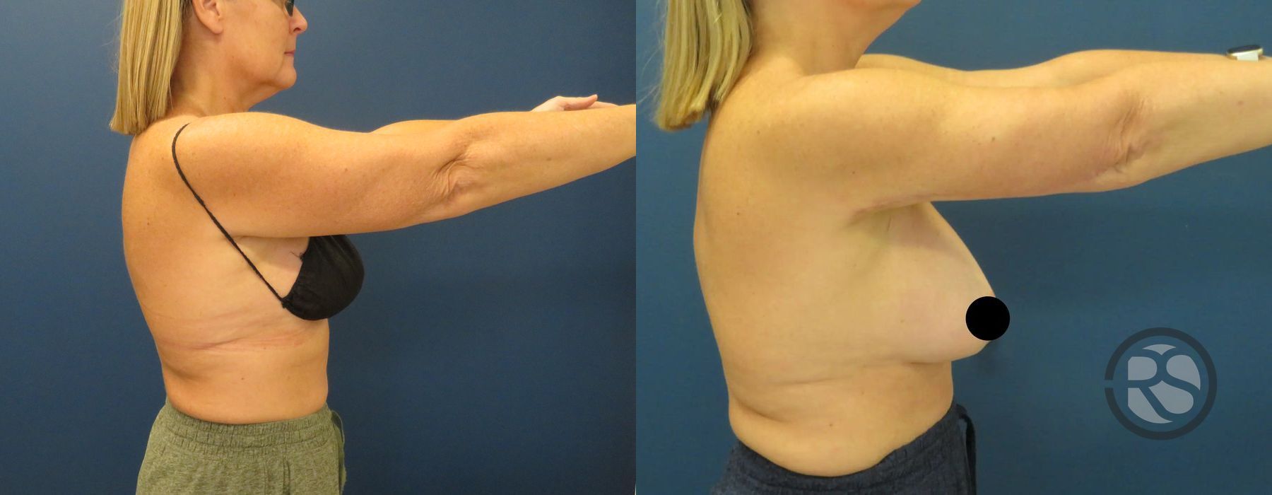 Before photo - Angle 3