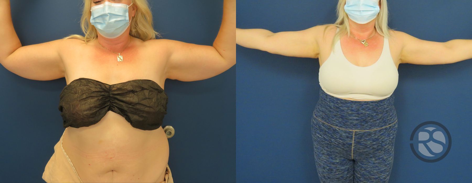 Before photo - Angle 2