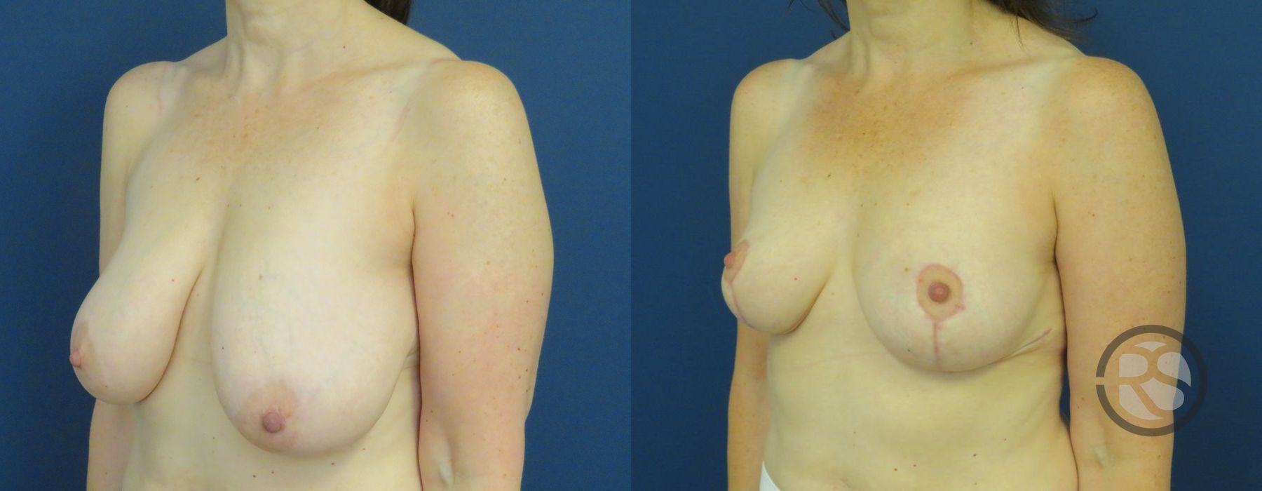 Before photo - Angle 4