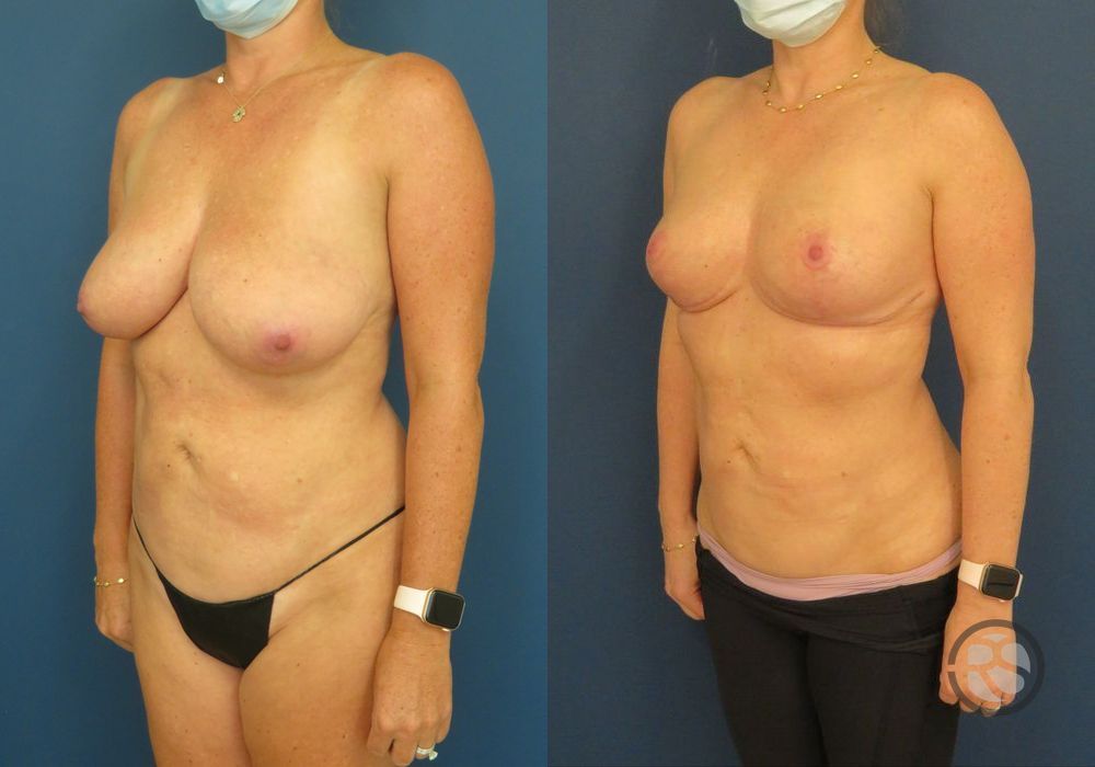 Before photo - Angle 4