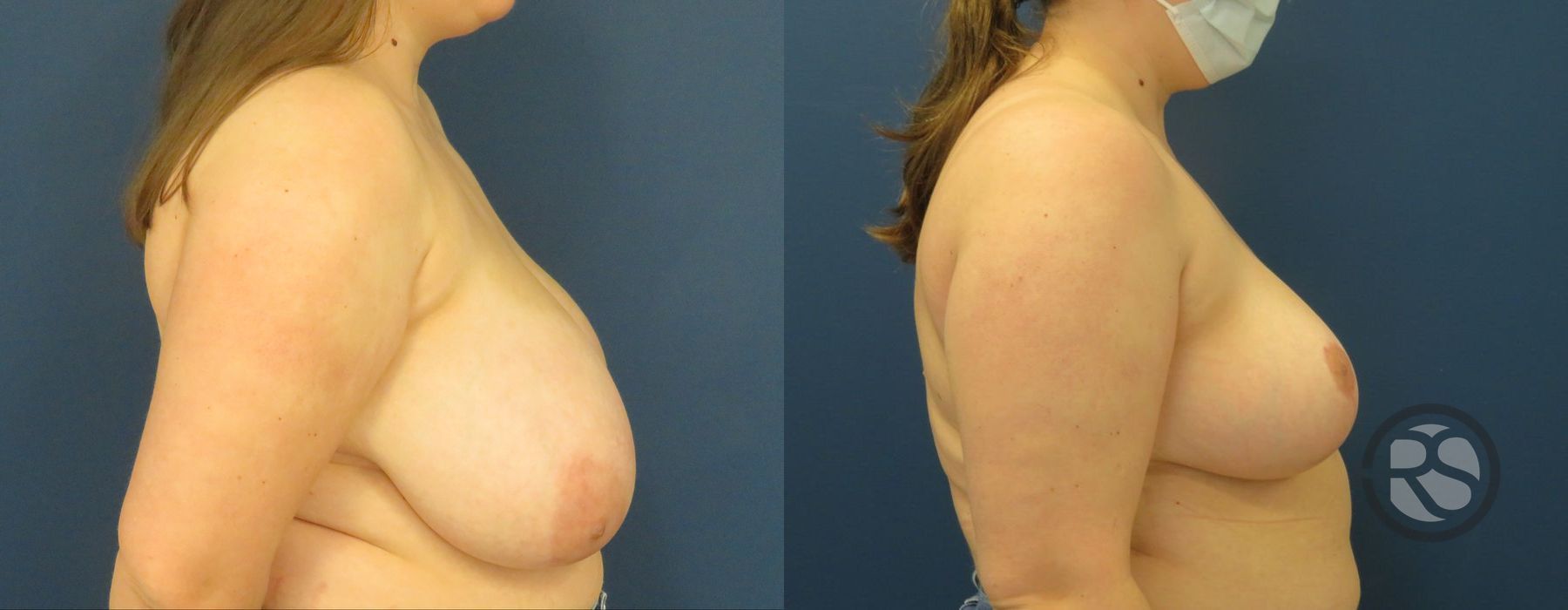 Before photo - Angle 3