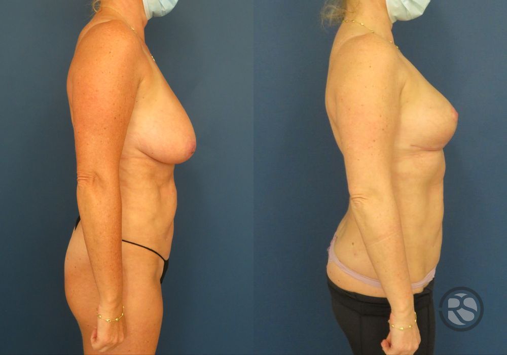 Before photo - Angle 3