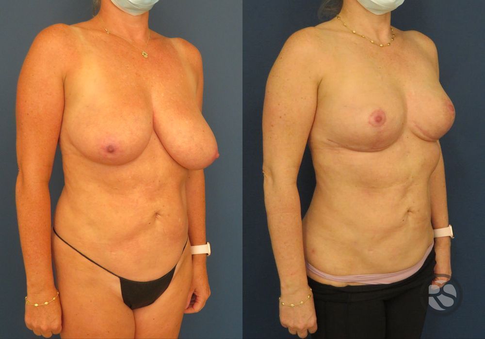 Before photo - Angle 2