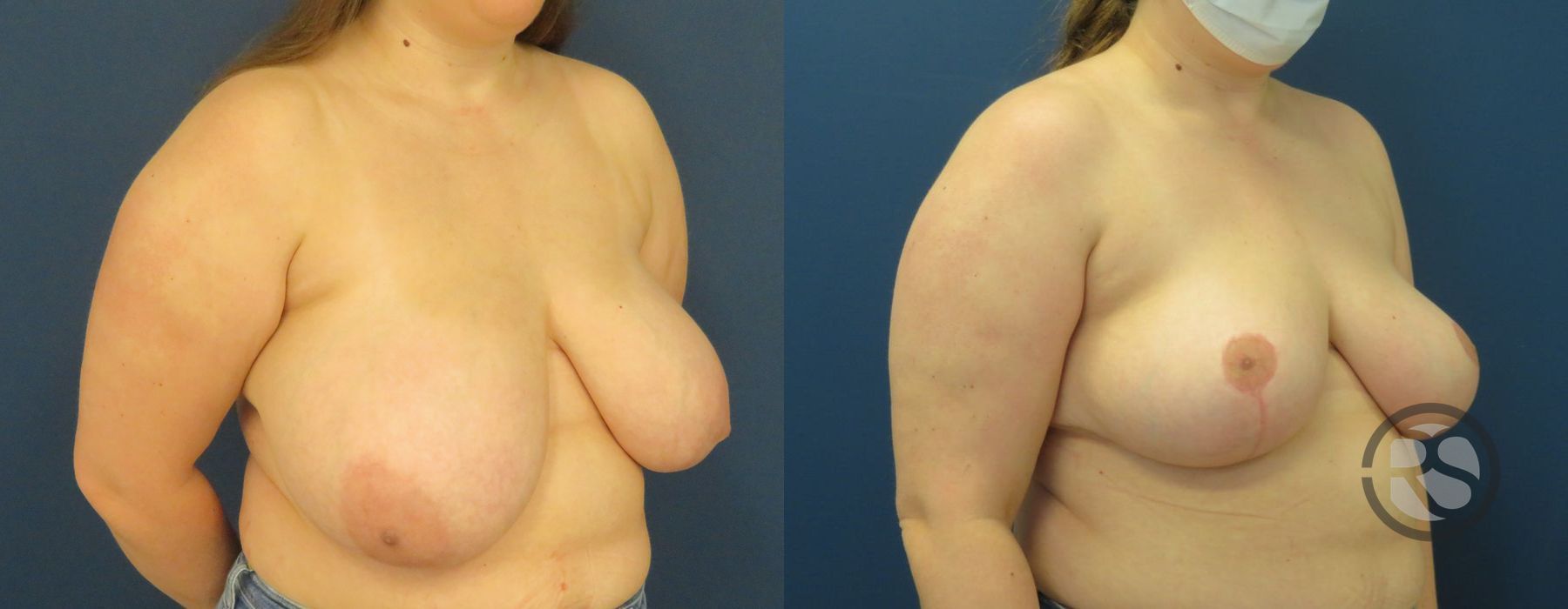 Before photo - Angle 2