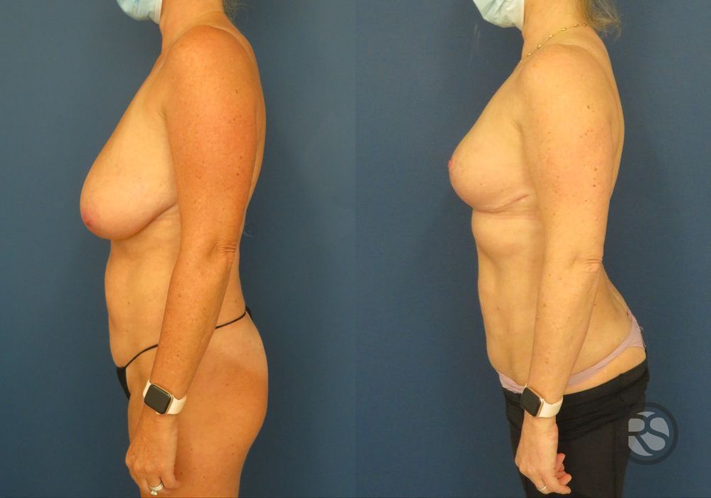 Before photo - Angle 5