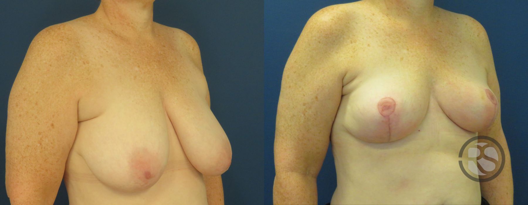 Before photo - Angle 2