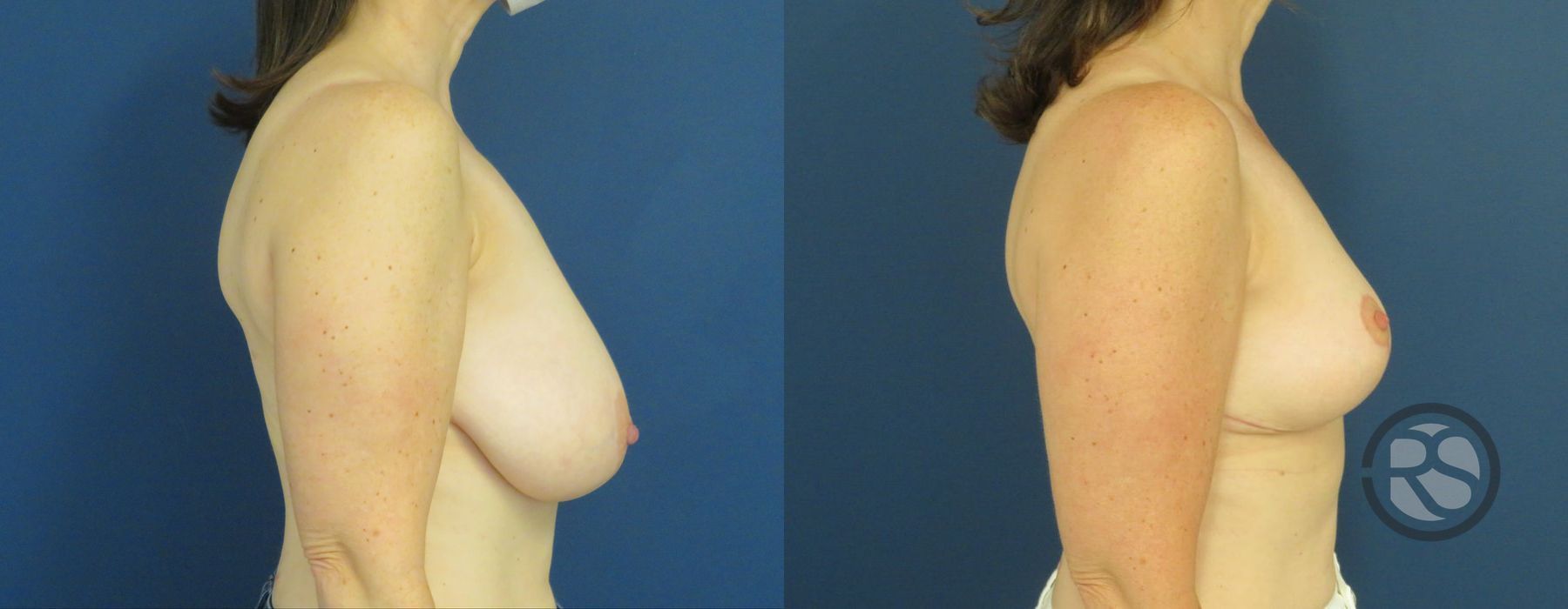 Before photo - Angle 3