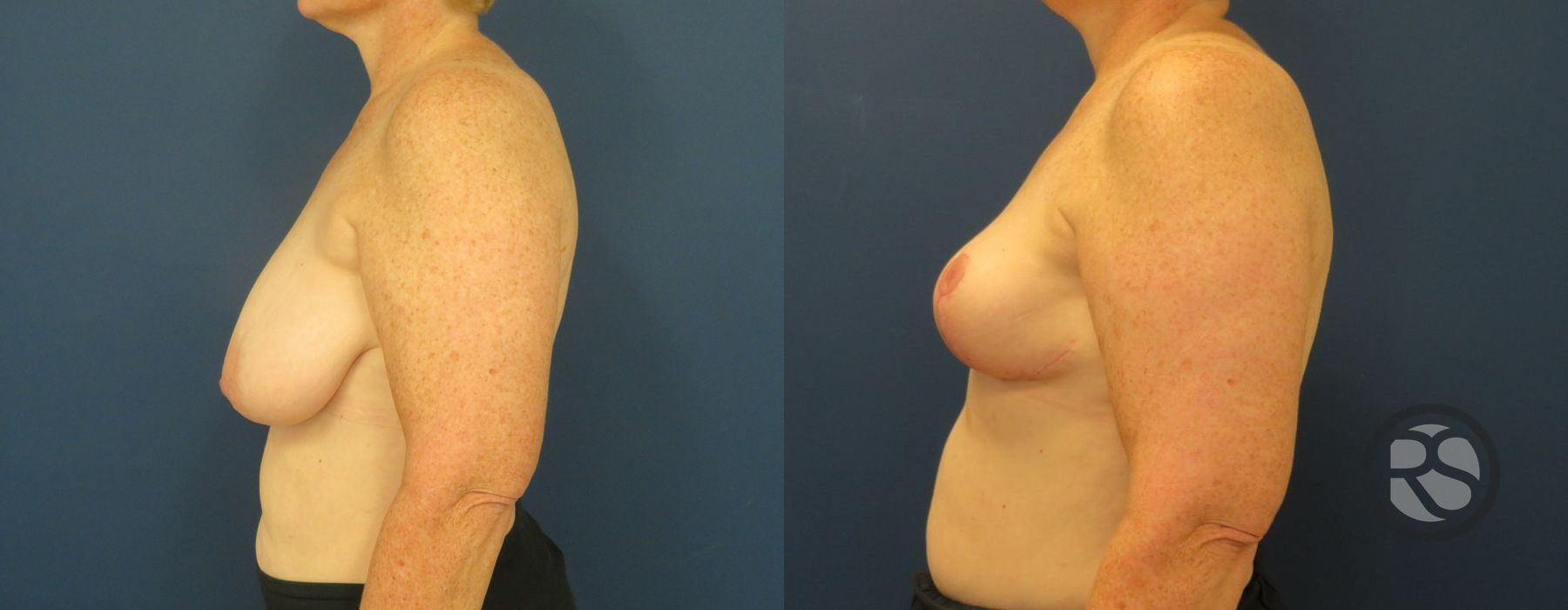 Before photo - Angle 5