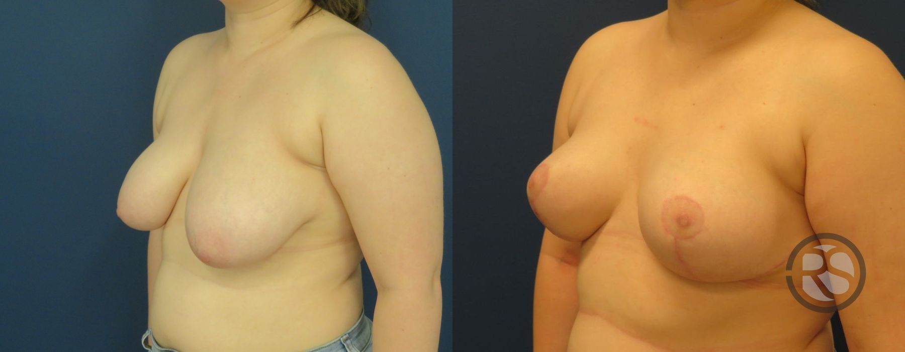 Before photo - Angle 4