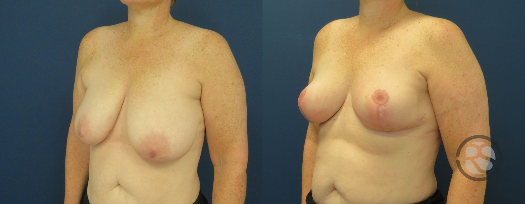 Before photo - Angle 4