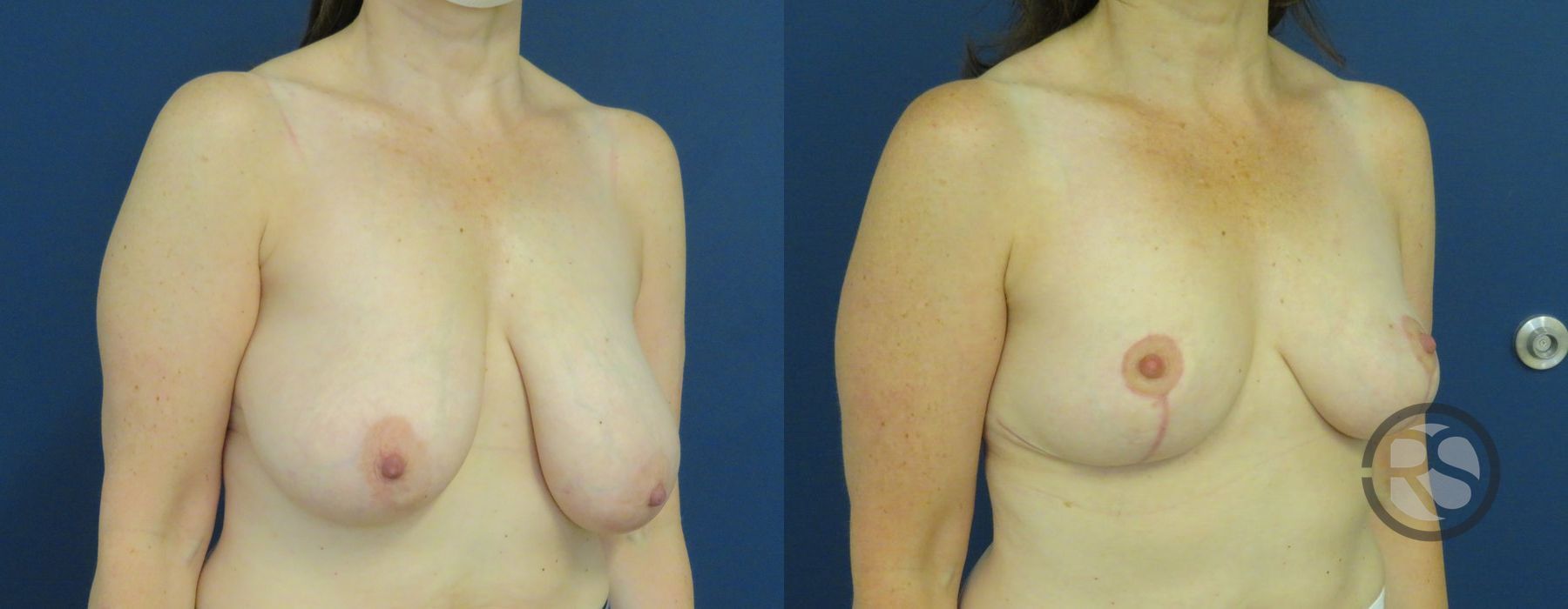 Before photo - Angle 2