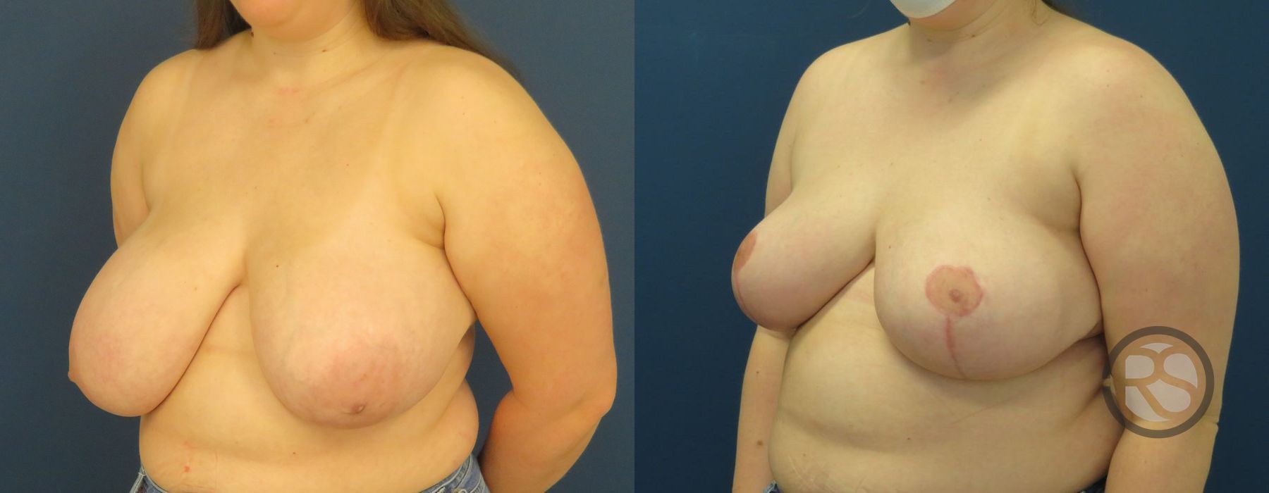 Before photo - Angle 4