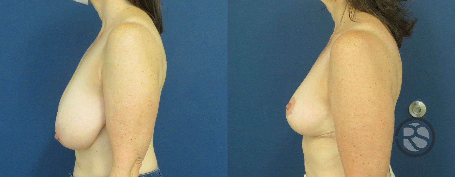 Before photo - Angle 5