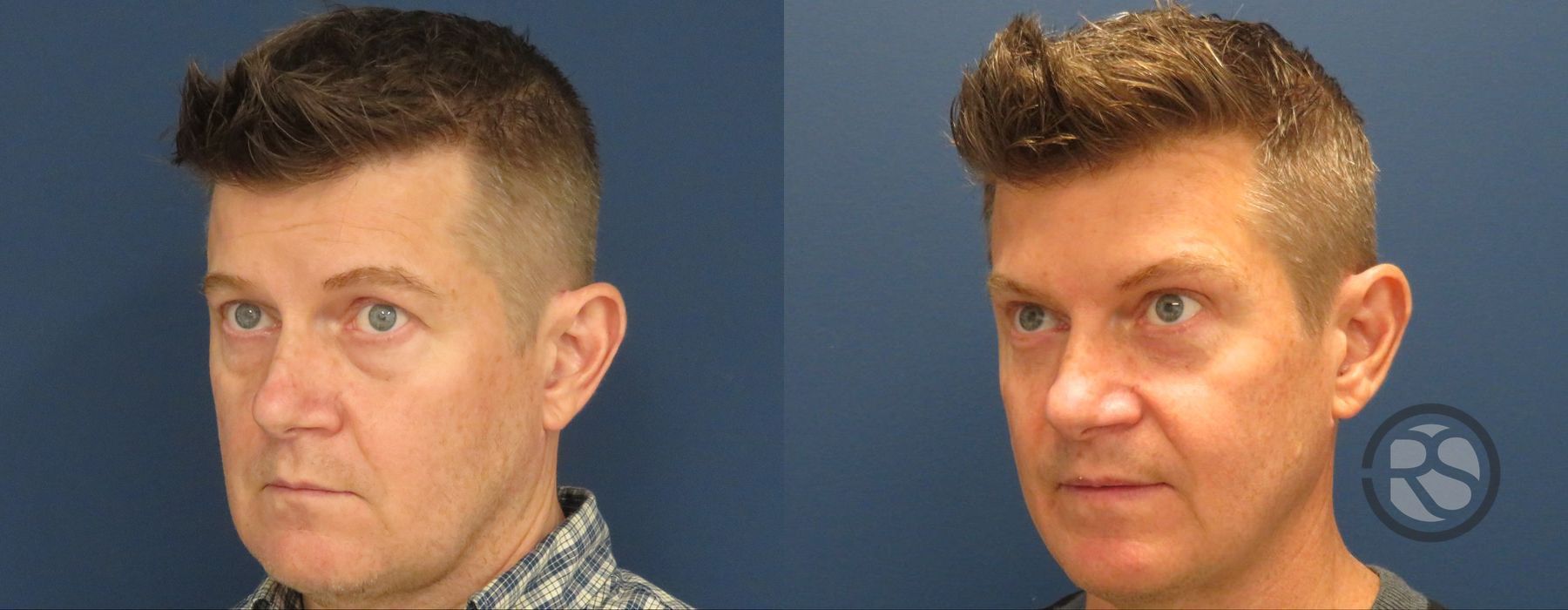 Before photo - Angle 4