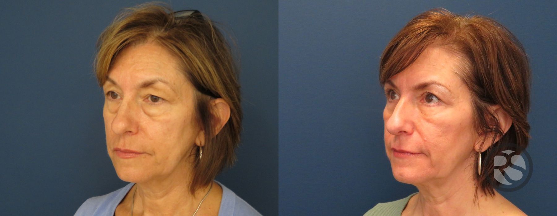 Before photo - Angle 4