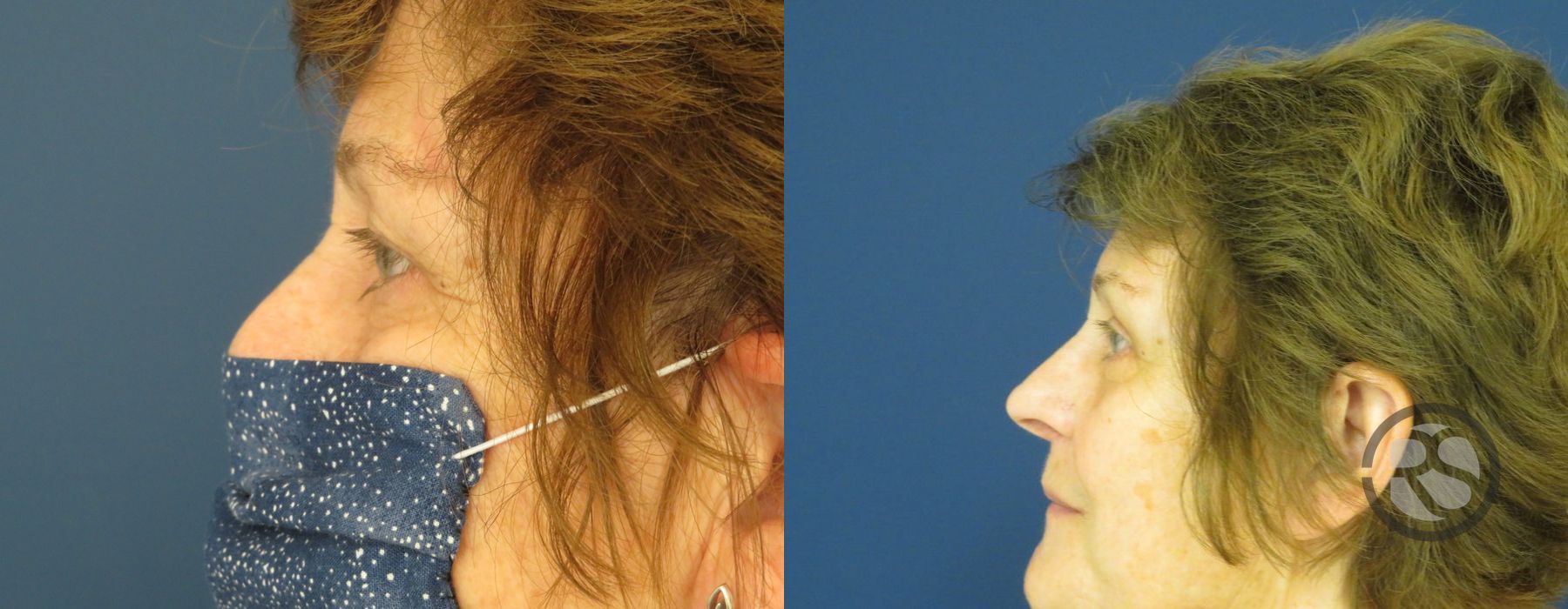 Before photo - Angle 5