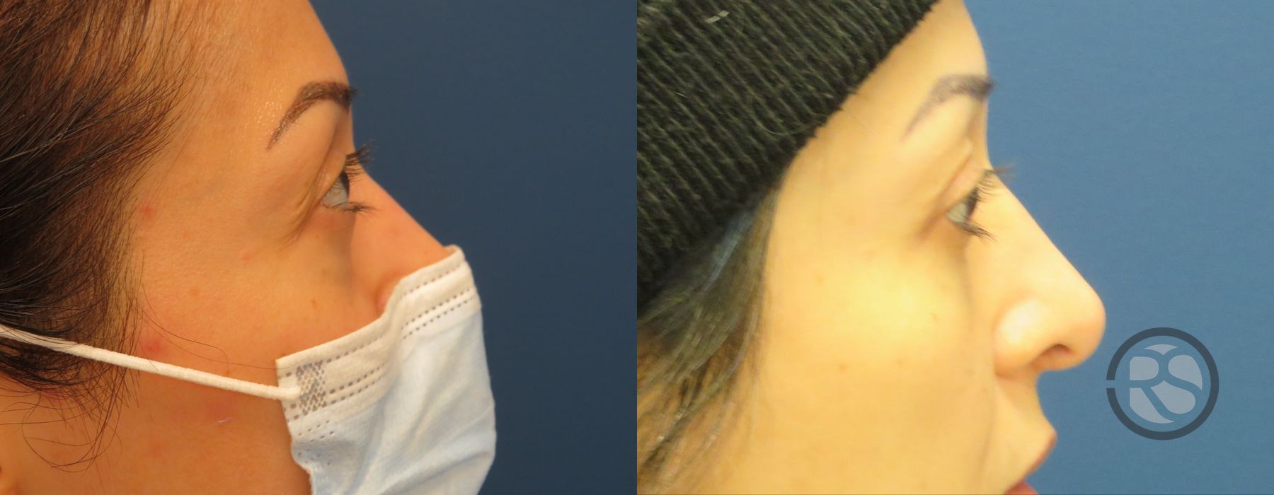 Before photo - Angle 3