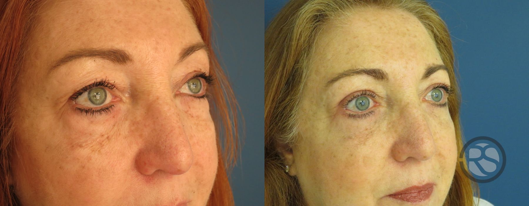 Before photo - Angle 2