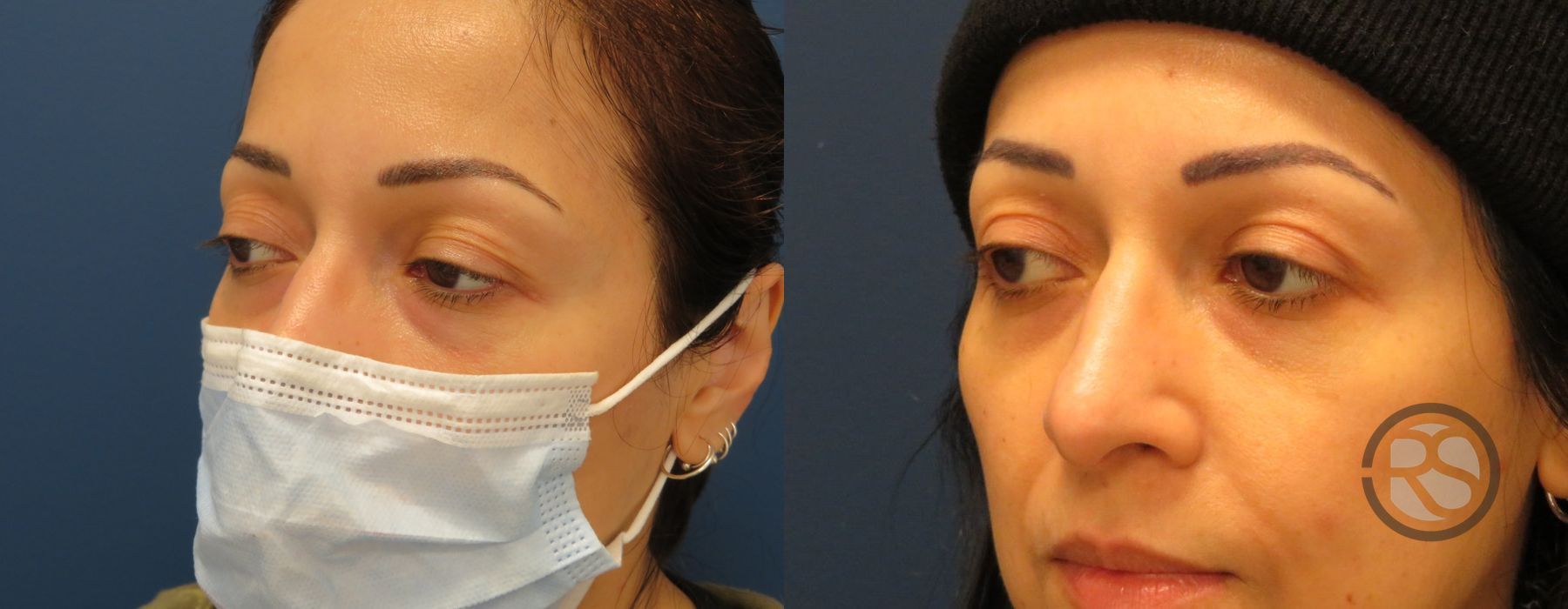 Before photo - Angle 4