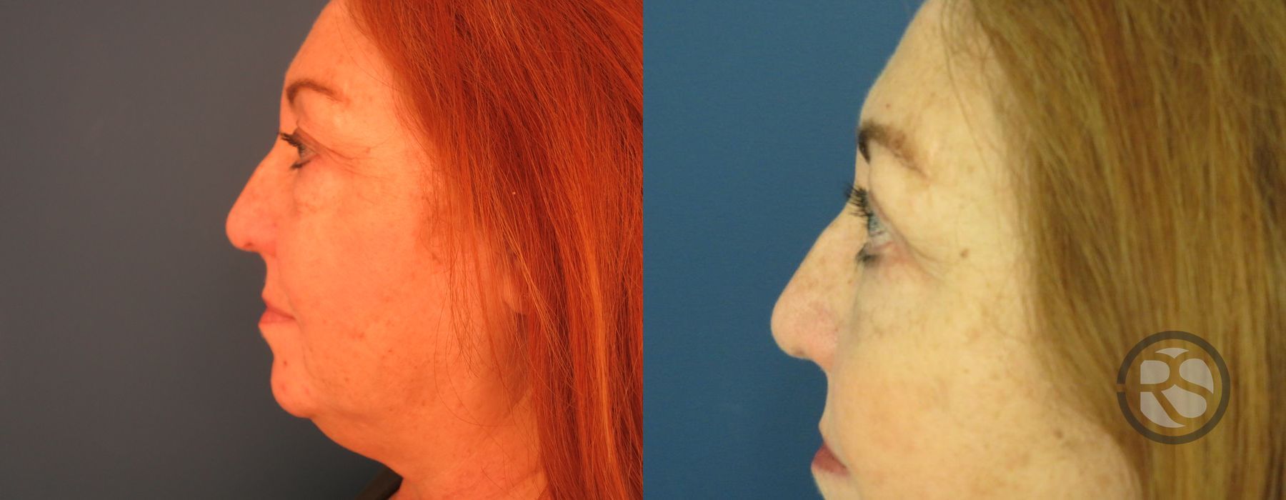 Before photo - Angle 5