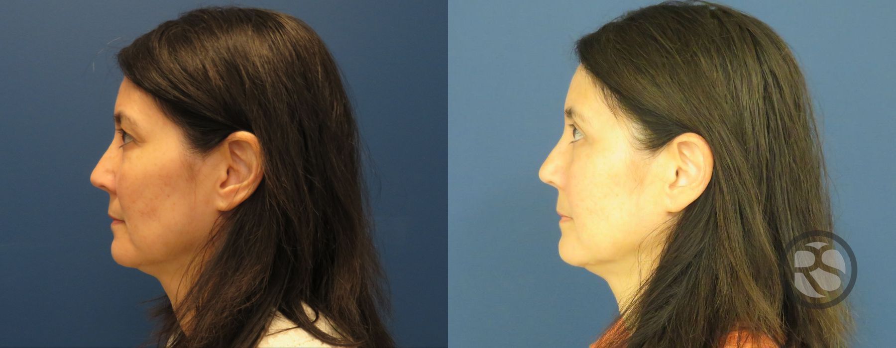 Before photo - Angle 5