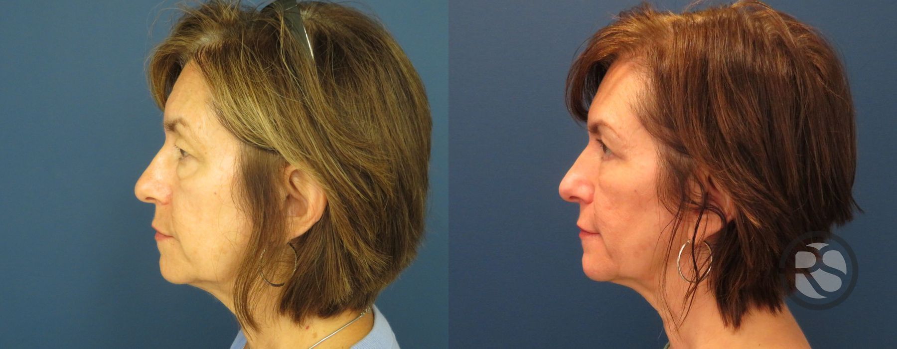 Before photo - Angle 5