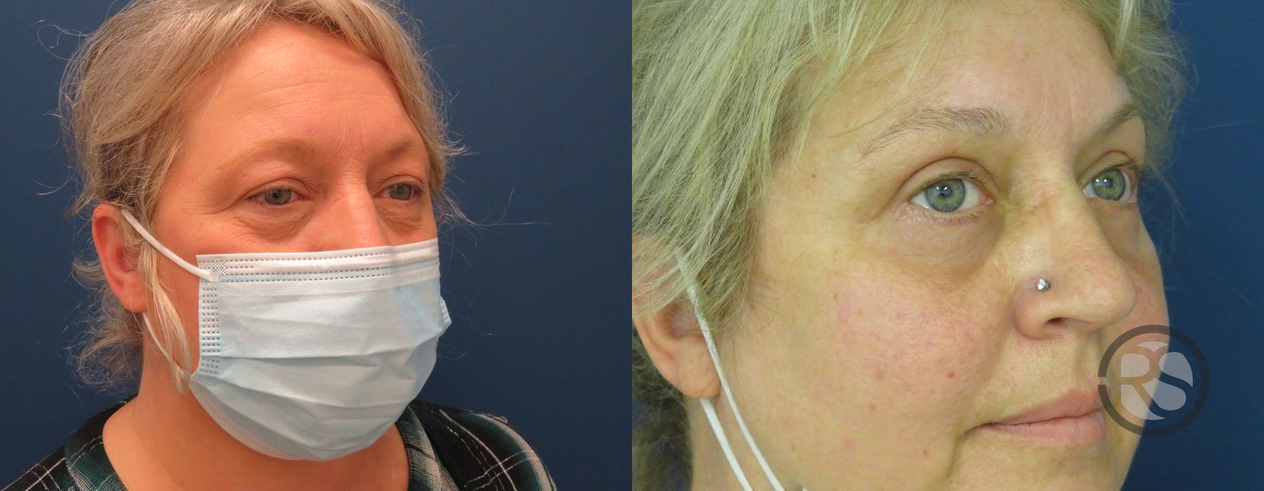 Before photo - Angle 2