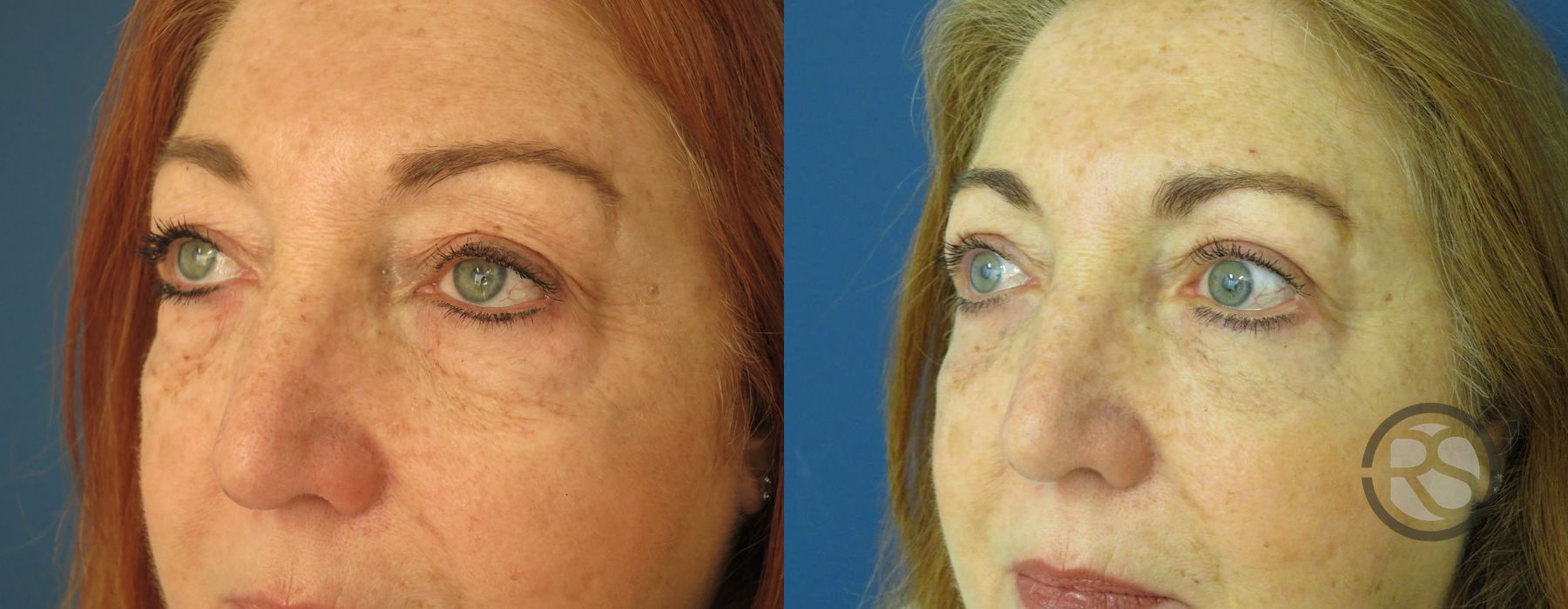 Before photo - Angle 4