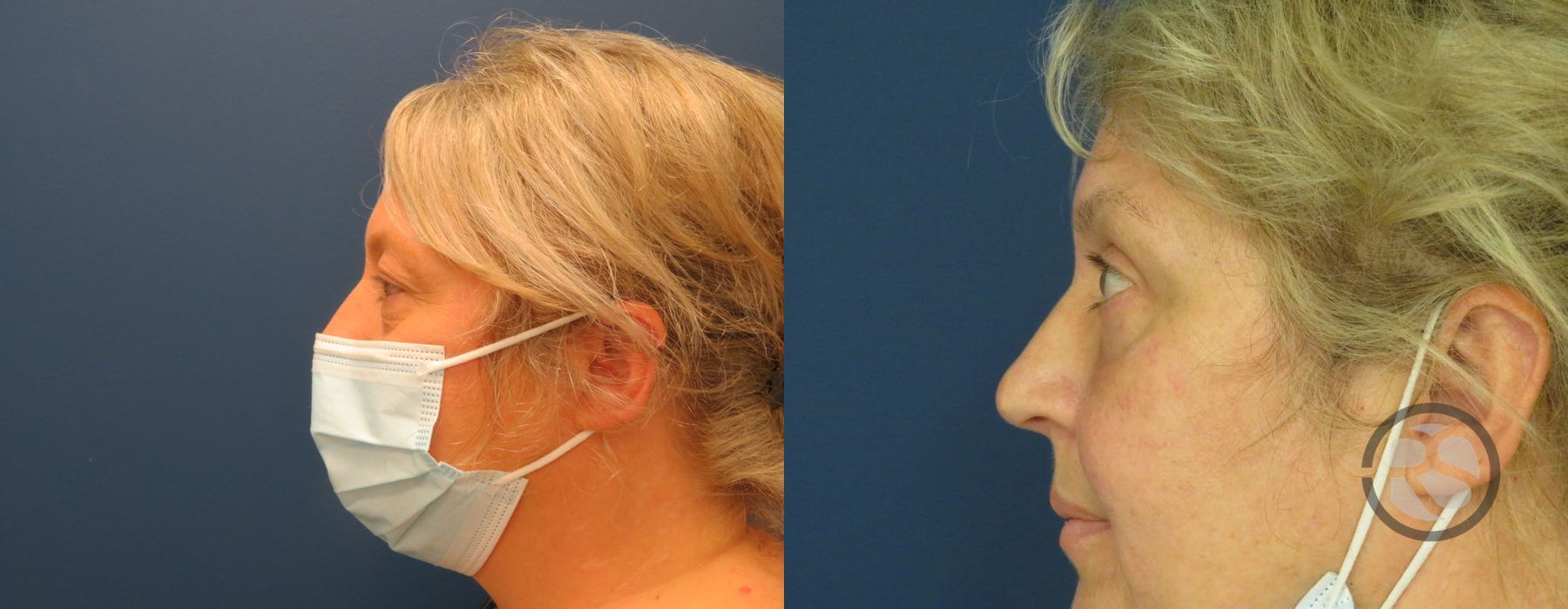 Before photo - Angle 5