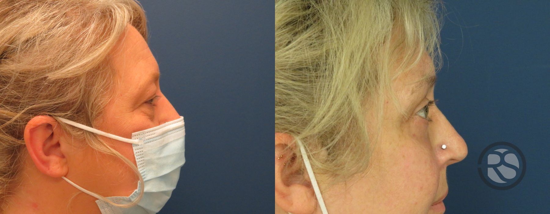 Before photo - Angle 3