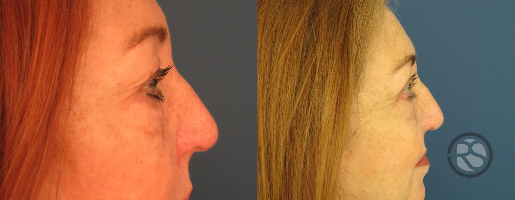 Before photo - Angle 3