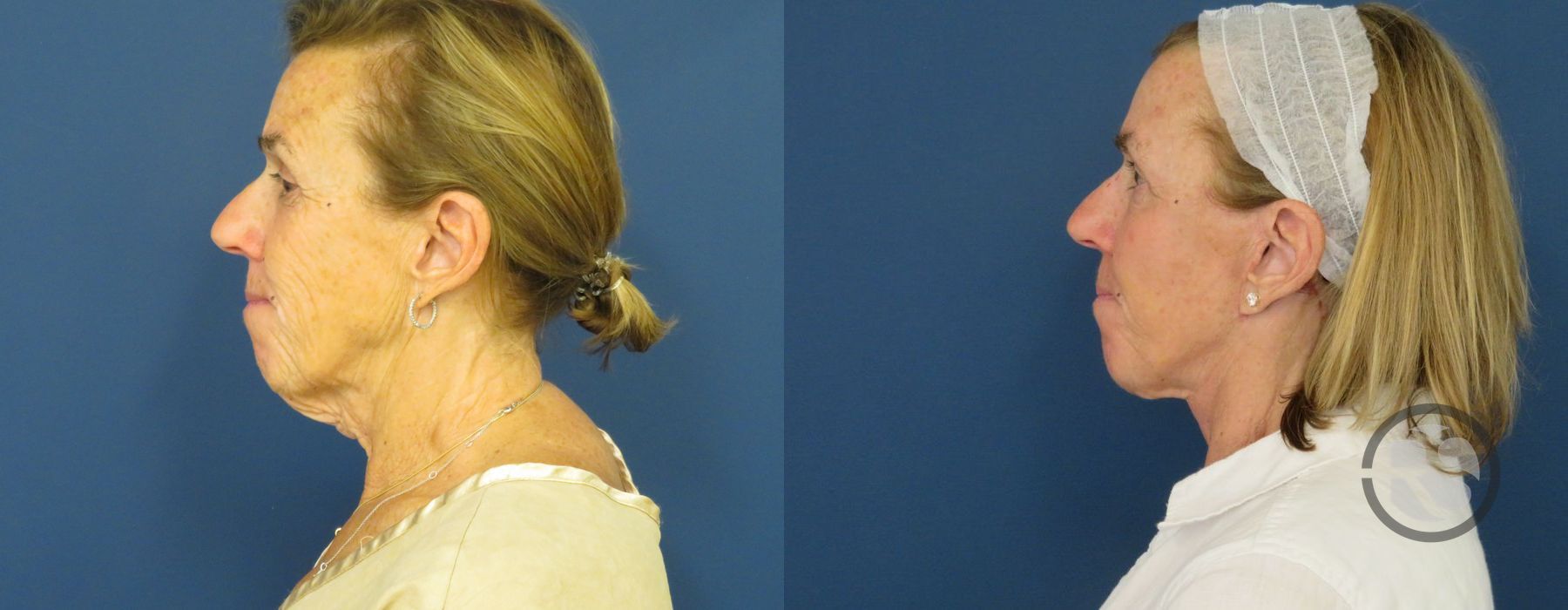 Before photo - Angle 5