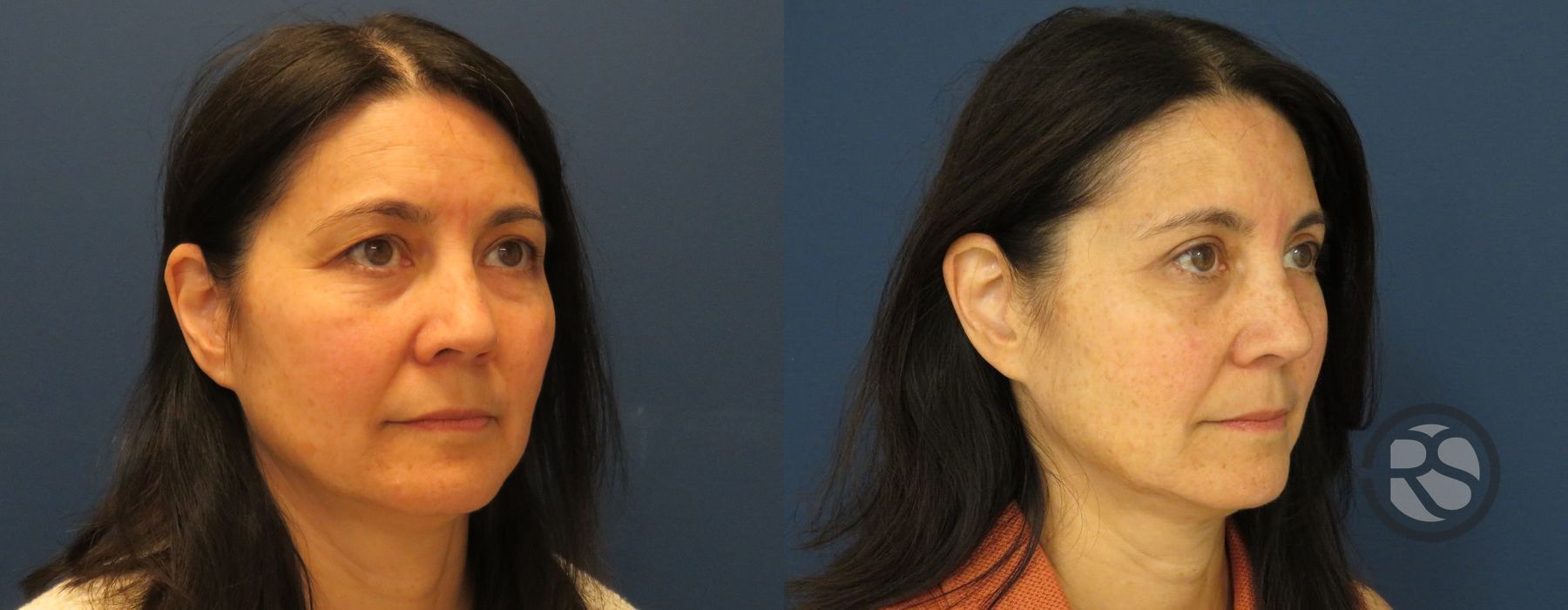 Before photo - Angle 2