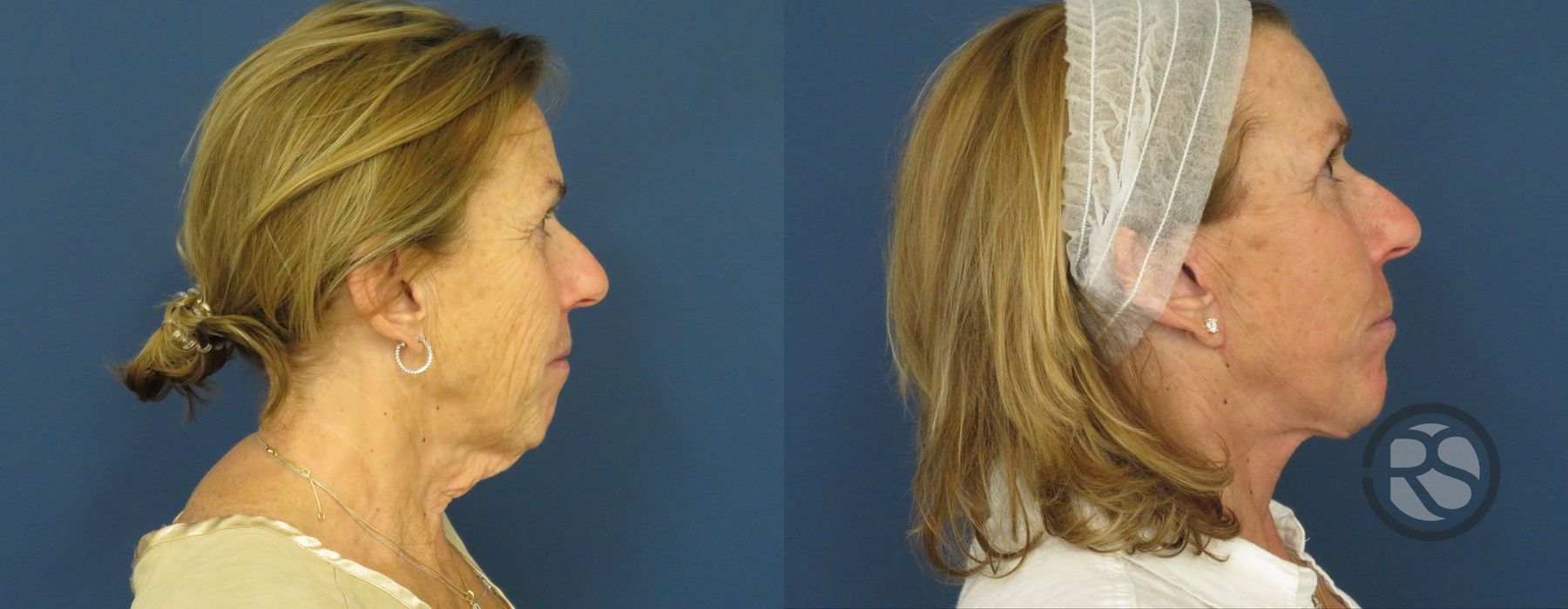 Before photo - Angle 3