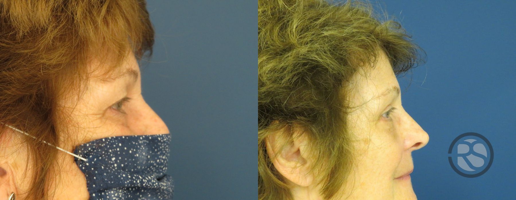 Before photo - Angle 3