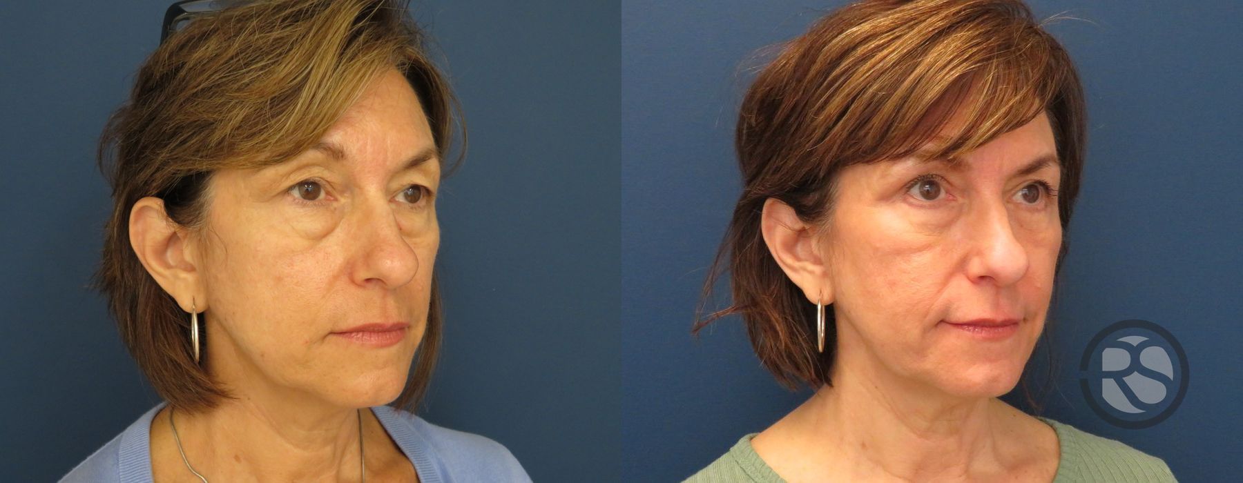 Before photo - Angle 2