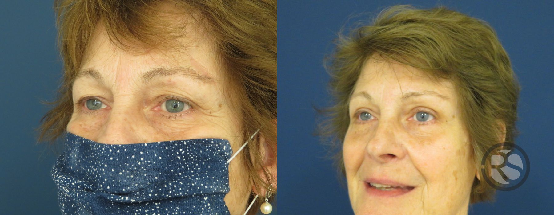 Before photo - Angle 4