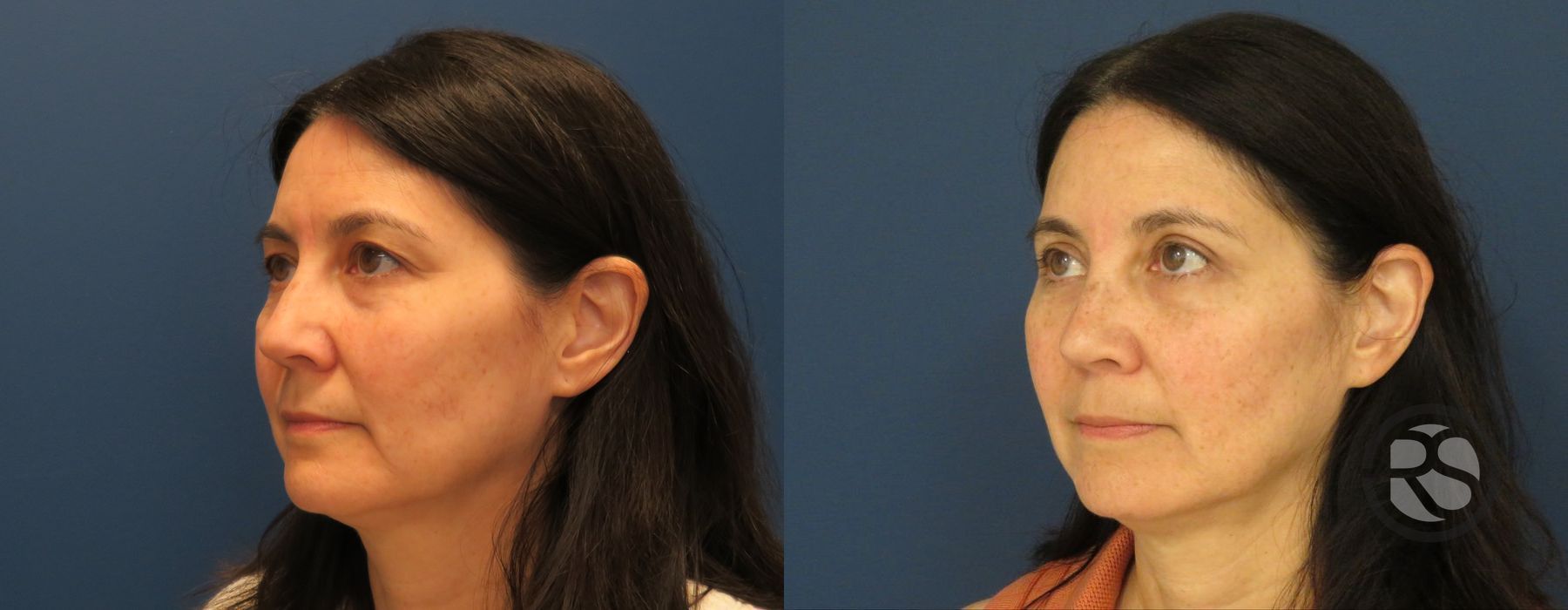 Before photo - Angle 4