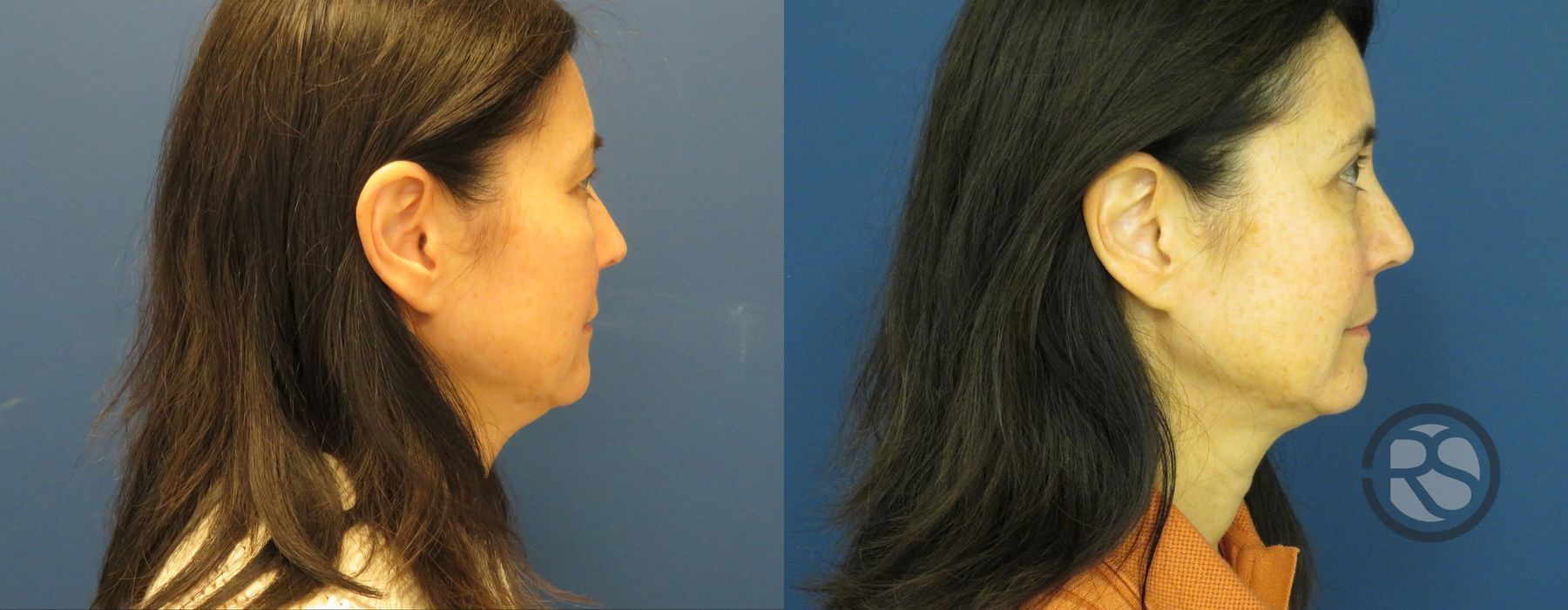 Before photo - Angle 3