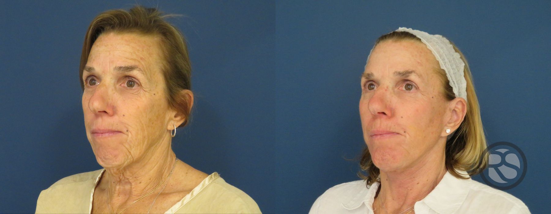 Before photo - Angle 4