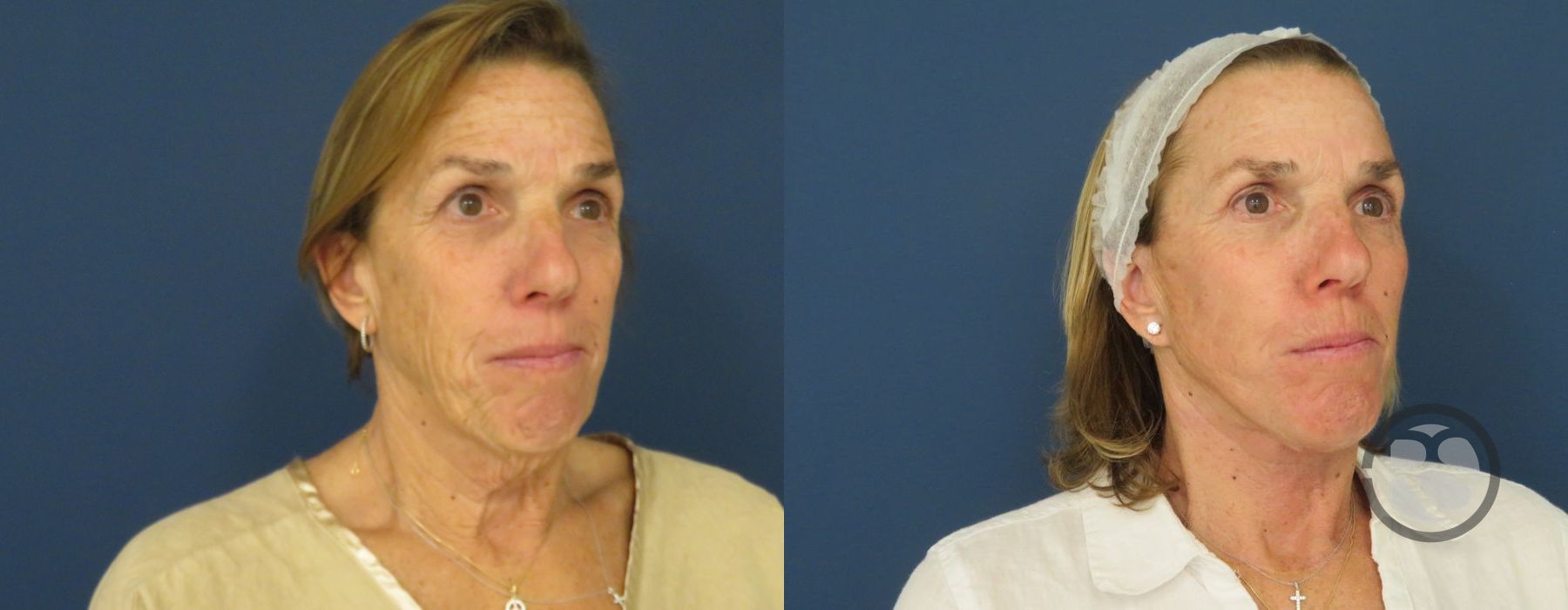 Before photo - Angle 2