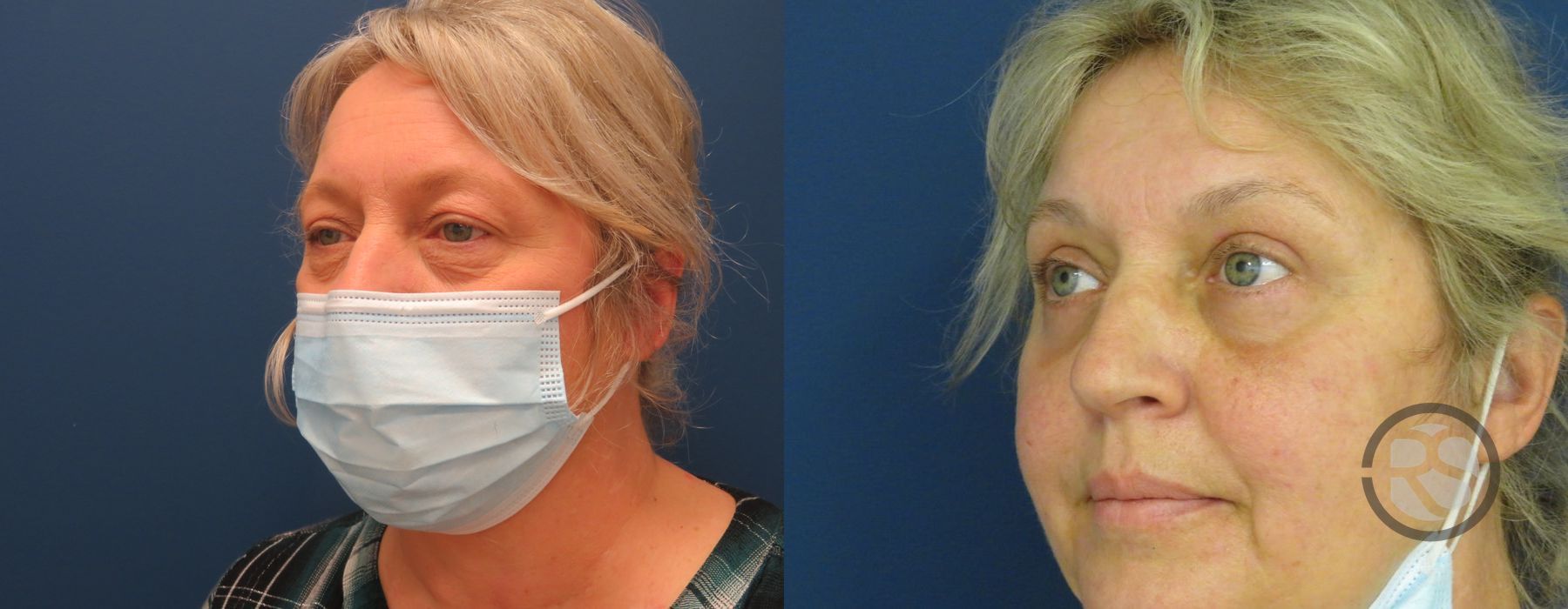 Before photo - Angle 4