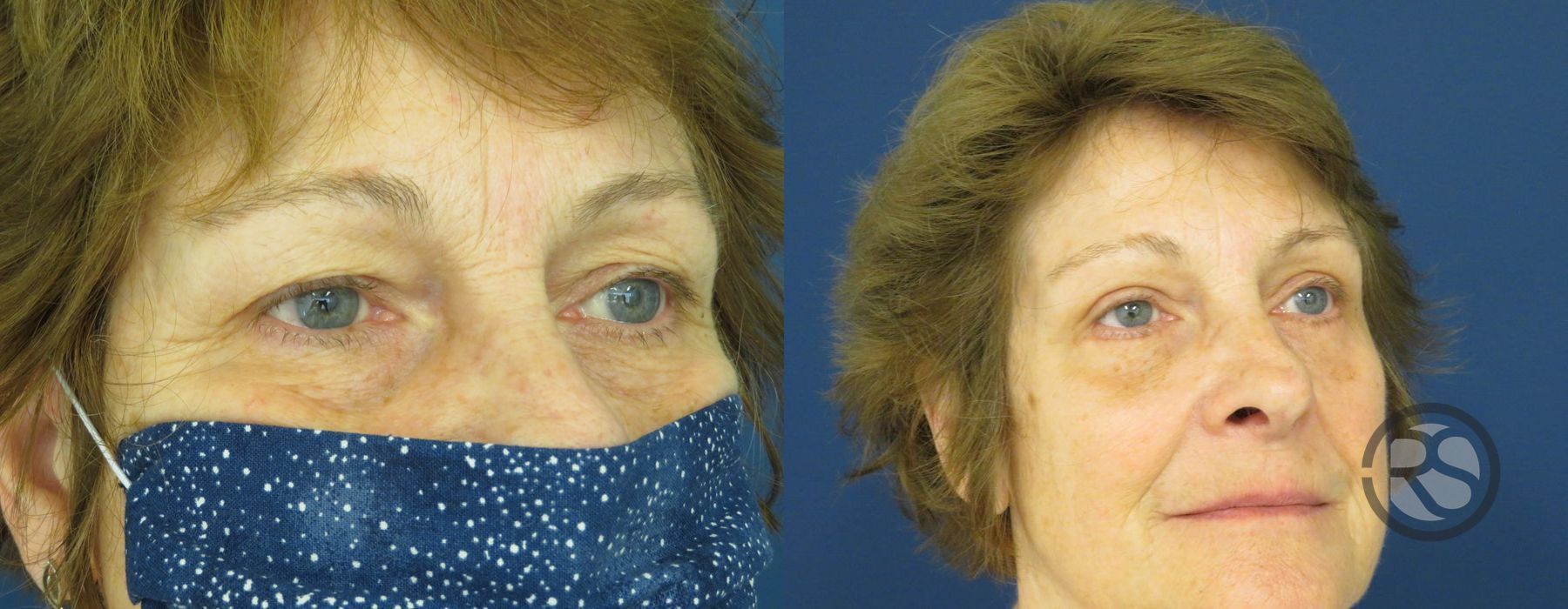 Before photo - Angle 2