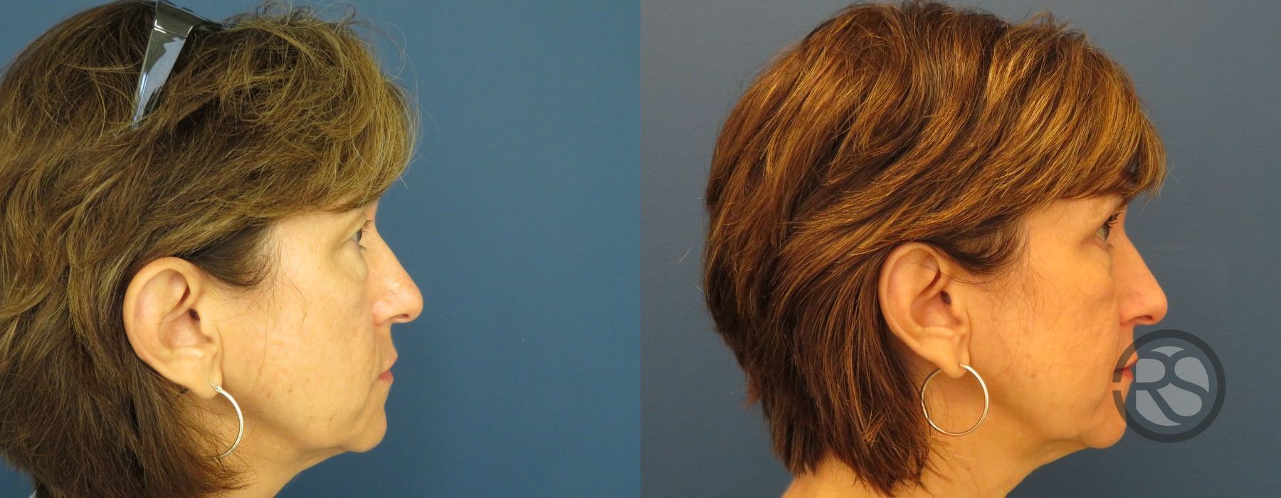 Before photo - Angle 3