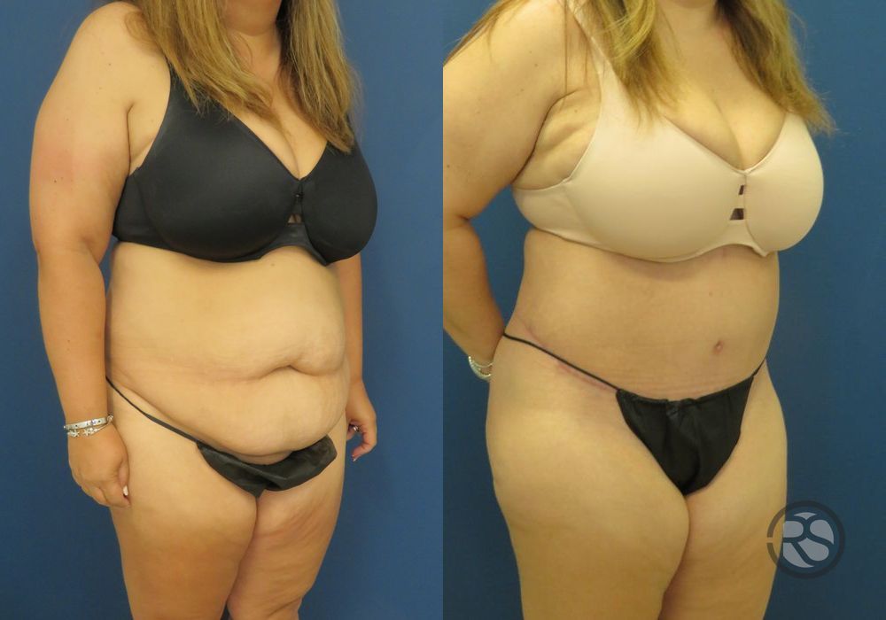 Before photo - Angle 2