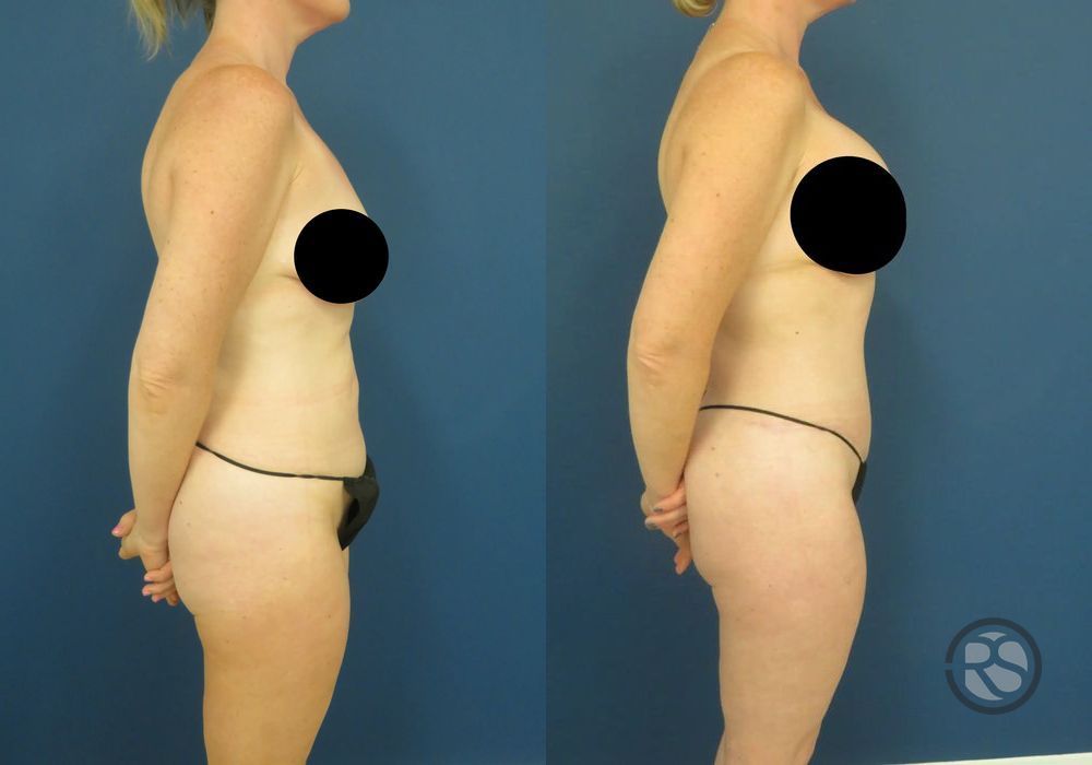 Before photo - Angle 3